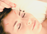 Photo of Cosmetic Acupuncture